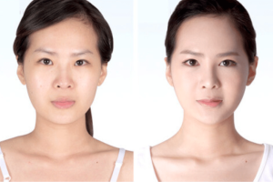 Chia sẻ kinh nghiệm cấy mỡ mặt Babyface trẻ hóa da