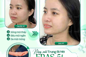 Tư vấn nâng mũi sụn tự thân cho da mũi mỏng