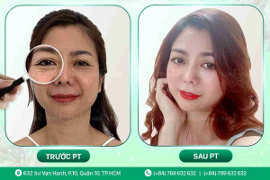 Phẫu thuật căng da mặt tại ở đâu tốt?