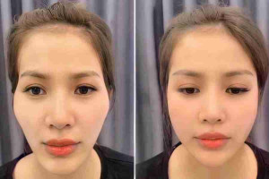 Tiêm cân chỉnh khuôn mặt bằng filler có tốt không?
