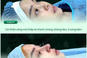 Ưu nhược điểm của nâng mũi sống surgiform