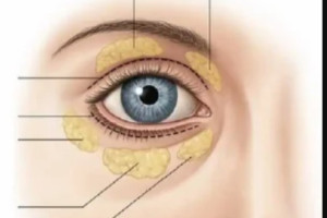 Tổng quan về cấy mỡ tự thân hốc mắt