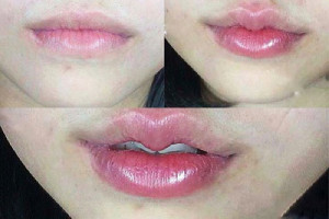 Sự thật phẫu thuật môi trái tim không đau