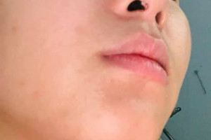 Tìm kiếm giải pháp sửa mũi hỏng sau phẫu thuật đúng cách