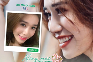 Nâng mũi siêu vi phẫu không nẹp cứng, 3 ngày vào form
