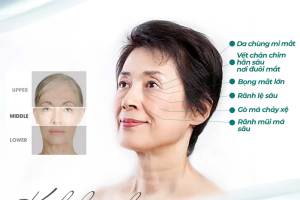 Giá trị đặc biệt của căng da Midface 6 trong 1