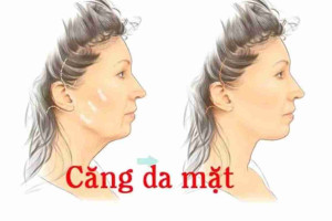 Trước khi căng da mặt toàn phần cần phải lưu ý gì?