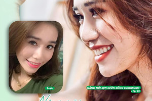 9 bước trong quy trình nâng mũi sống Surgiform chuẩn Y khoa