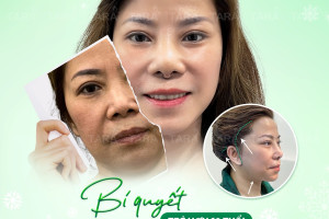 Căng da mặt toàn phần ở đâu thì tốt và  tiêu chí lựa chọn
