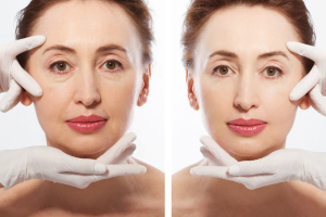 Căng da Midface có thể đi làm lại ngay không?