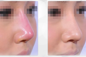 Da mũi mỏng có nâng mũi cấu trúc được không?