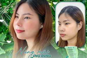 Review nâng mũi không đau tại TARA Beauty Clinic