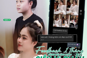 Siêu vi phẫu – Xu hướng nâng mũi tự nhiên không đau mới nhất