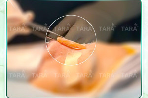 3 lầm tưởng nghiêm trọng về nâng mũi sụn sườn