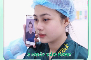 Nâng mũi ứng dụng đeo kính lúp siêu vi phẫu không đau bằng sụn tự thân