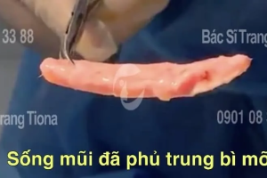 Lấy trung bì mỡ của người khác nâng mũi được không?
