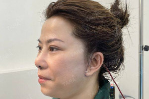 Căng da mặt nội soi là gì? Thực hiện như thế nào?