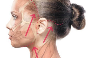 Căng da mặt toàn phần giúp trẻ hoá những phần nào?