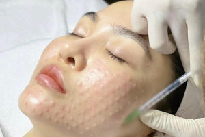 Review tiêm căng bóng: Kinh nghiệm của khách hàng 