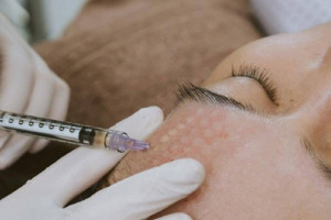 Tiêm căng bóng trẻ hoá da có nguy hiểm không?