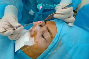 Lợi ích kỳ diệu của việc đặt trung bì mỡ khi tháo sụn mũi