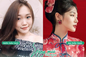 7 kinh nghiệm chọn địa chỉ nâng mũi đẹp tại Sài Gòn