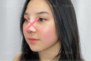Nâng mũi không nẹp cứng có an toàn không?