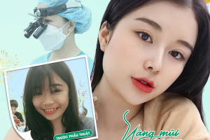 Nâng mũi ứng dụng đeo kính lúp siêu vi phẫu: Giải pháp hoàn hảo cho người bận rộn