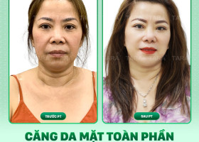 Chi phí phẫu thuật căng da mặt toàn phần 2025