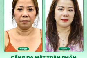 Chi phí phẫu thuật căng da mặt toàn phần 2025