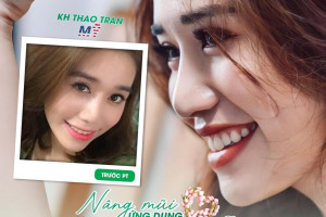 Phân biệt nâng mũi ứng dụng đeo kính lúp siêu vi phẫu và nâng mũi thường