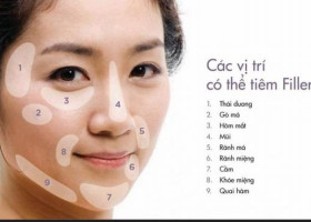 Bao lâu thấy hiệu quả khi tiêm filler tạo hình khuôn mặt?