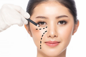 Vì sao căng da Midface là “liệu pháp trẻ hóa tầng giữa mặt 8 trong 1”?