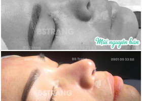 Nâng mũi siêu vi phẫu có đau không? Có để lại sẹo không?