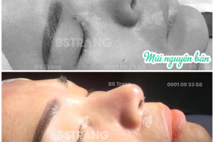 Nâng mũi siêu vi phẫu có đau không? Có để lại sẹo không?