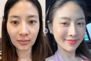 Cấy mỡ mặt có tan theo thời gian không?