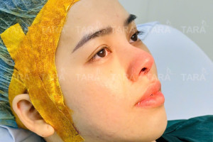 Cách chăm sóc sau nâng mũi siêu vi phẫu để có kết quả tốt nhất