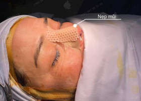 Tại sao cần nẹp cứng trong nâng mũi? Không có có sao không?