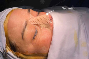 Tại sao cần nẹp cứng trong nâng mũi? Không có có sao không?