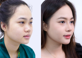 Nâng mũi siêu vi phẫu bao lâu thì lành và đẹp tự nhiên?