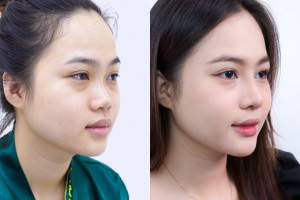 Nâng mũi siêu vi phẫu bao lâu thì lành và đẹp tự nhiên?