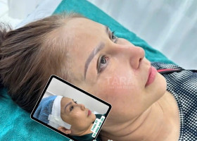 Nâng mũi siêu vi phẫu có sửa lại được không? Khi nào thì sửa được?