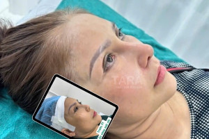 Nâng mũi siêu vi phẫu có sửa lại được không? Khi nào thì sửa được?