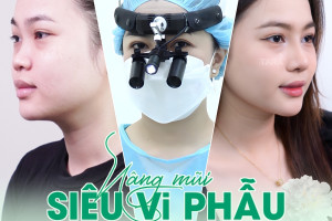 Nâng mũi siêu vi phẫu bằng sụn nhân tạo: Lựa chọn phù hợp cho từng dáng mũi
