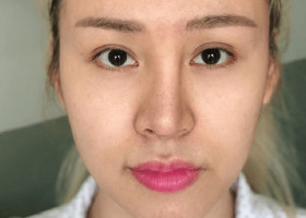 Nâng mũi siêu vi phẫu và những biến chứng có thể xảy ra