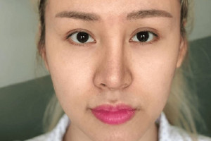 Nâng mũi siêu vi phẫu và những biến chứng có thể xảy ra