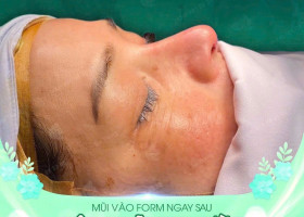 Nâng mũi siêu vi phẫu bằng sụn tự thân: Giải pháp tối ưu cho dáng mũi đẹp