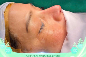 Nâng mũi siêu vi phẫu bằng sụn tự thân: Giải pháp tối ưu cho dáng mũi đẹp