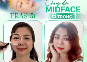 Phục hồi sau phẫu thuật căng da Midface và những điều cần lưu ý
