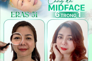 Phục hồi sau phẫu thuật căng da Midface và những điều cần lưu ý